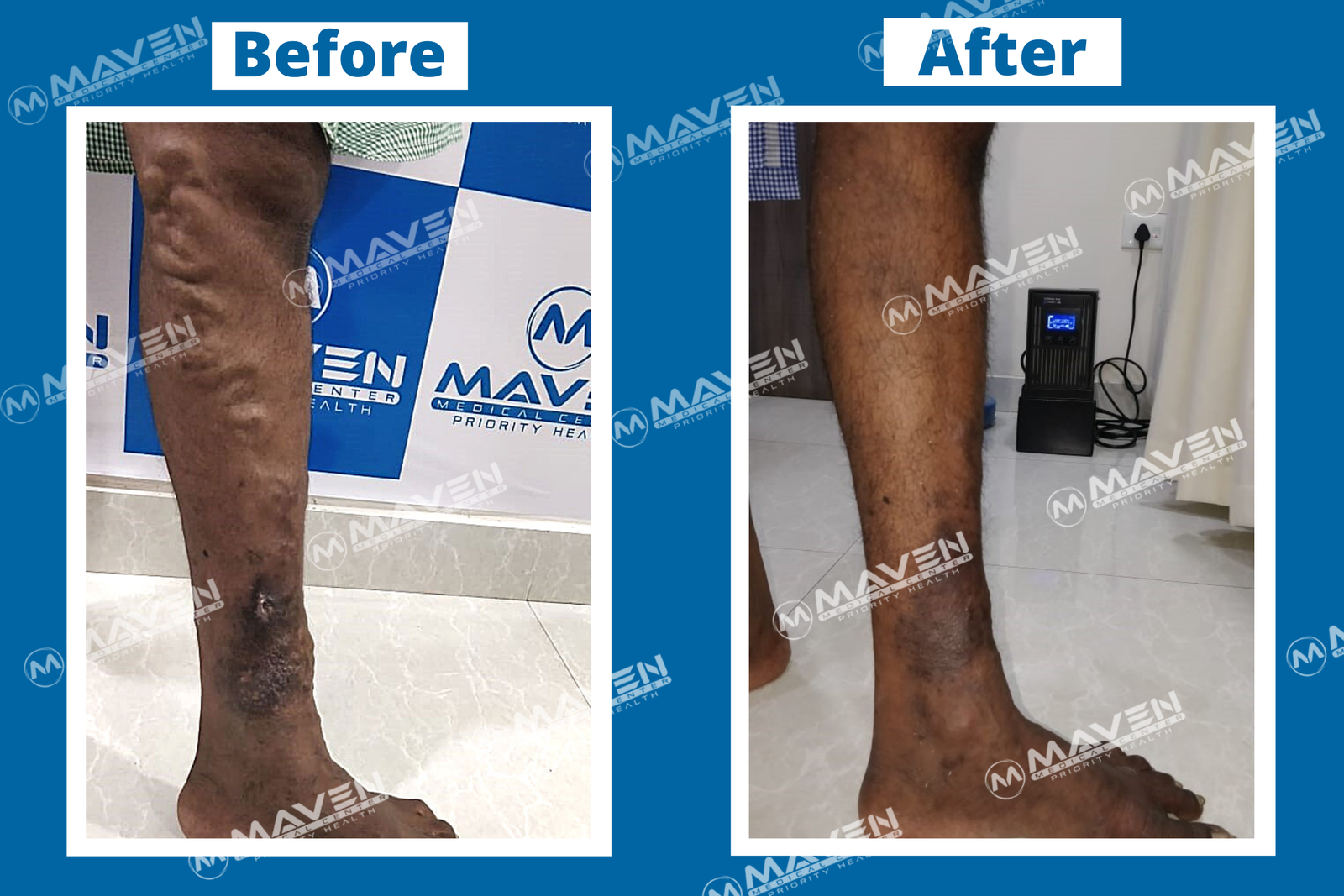 Varicose Veins Laser Treatment Before After Pictures At Maven Medical ...