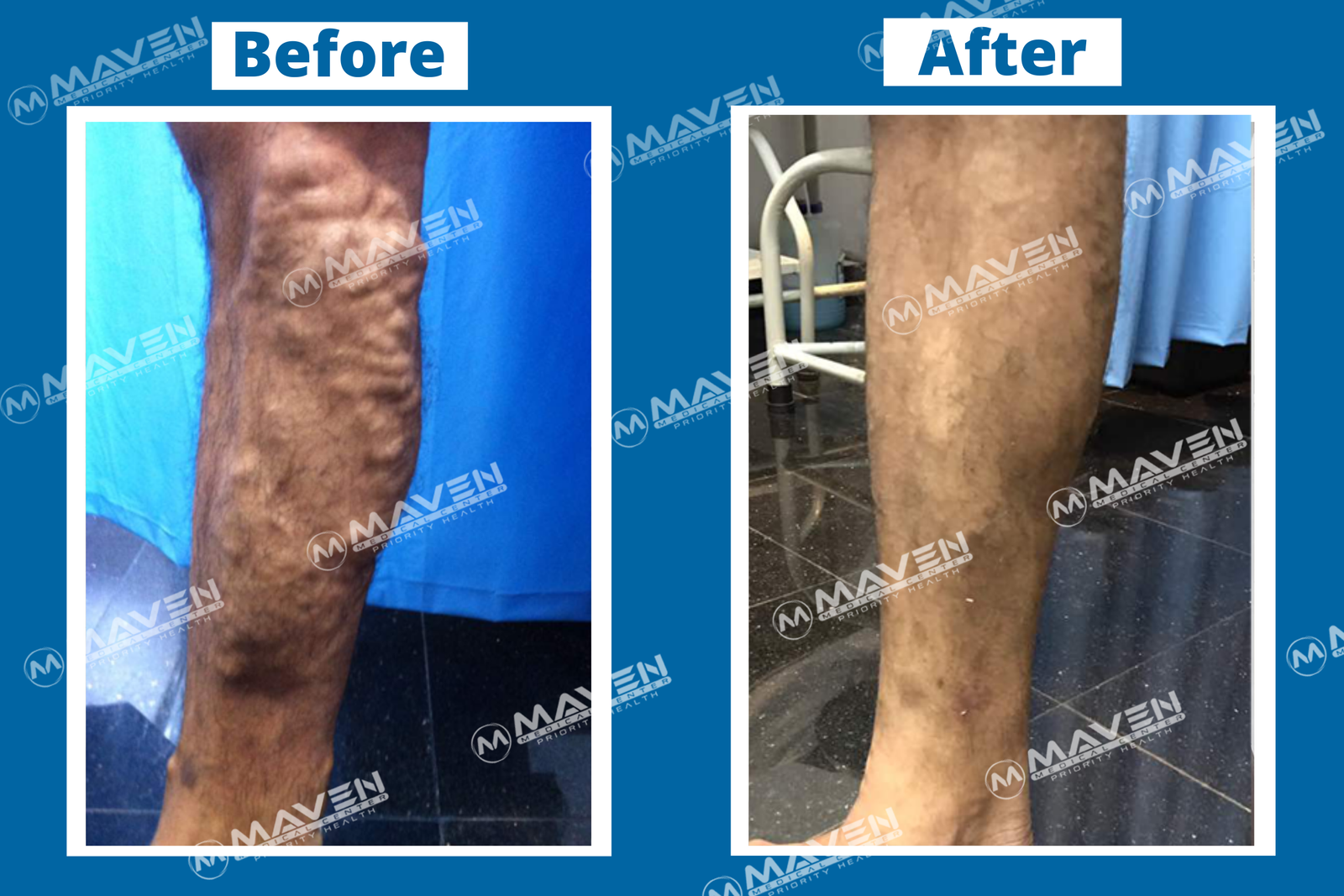 Varicose Veins Laser Treatment Before After Pictures At Maven Medical