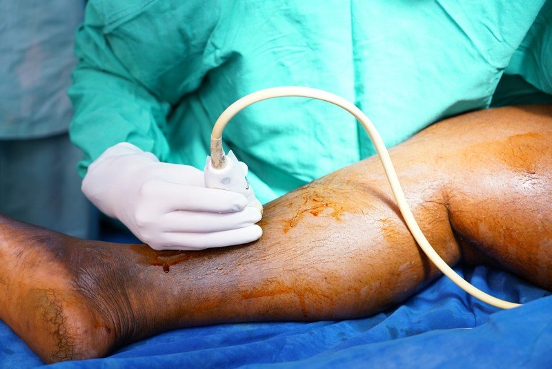 microwave ablation for varicose veins