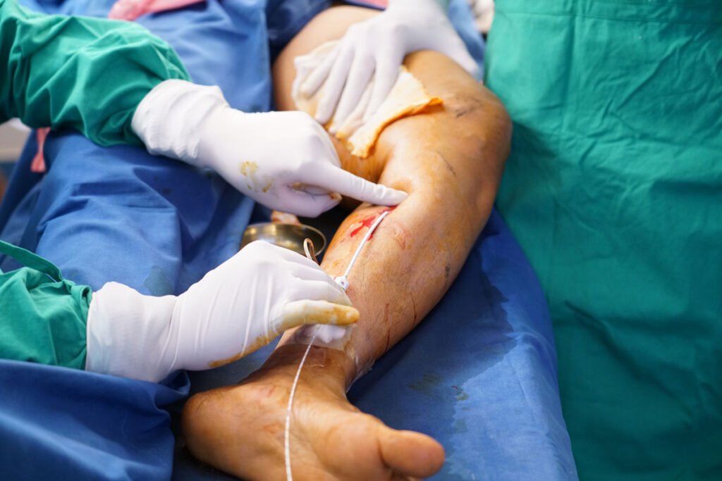 Microwave Ablation for Varicose Veins