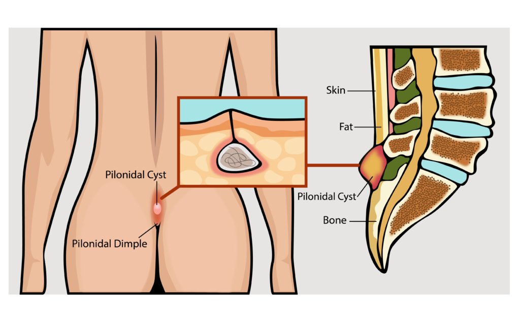 endoscopic ablation for a pilonidal sinus